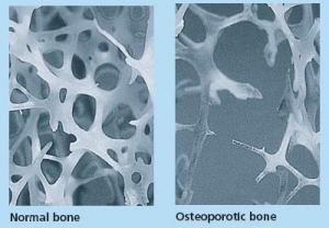 osteoporotic bone