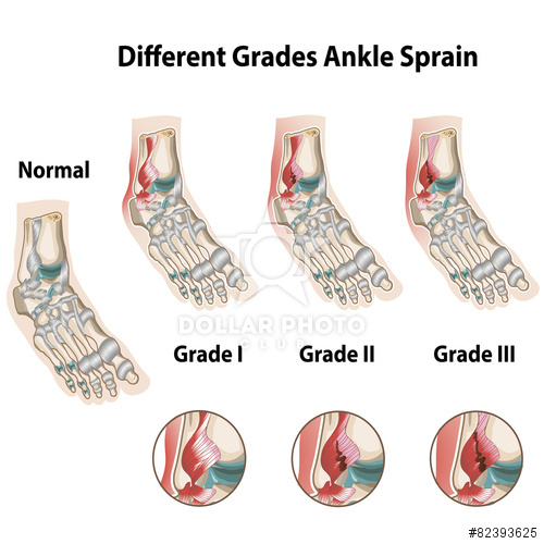 Ankle Sprains | Kilkenny Physiotherapy Clinic